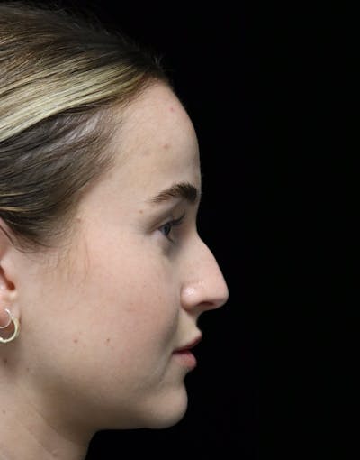 Beverly Hills Rhinoplasty Before & After Gallery - Patient 264675 - Image 1 Dr. Deepak Raj Dugar