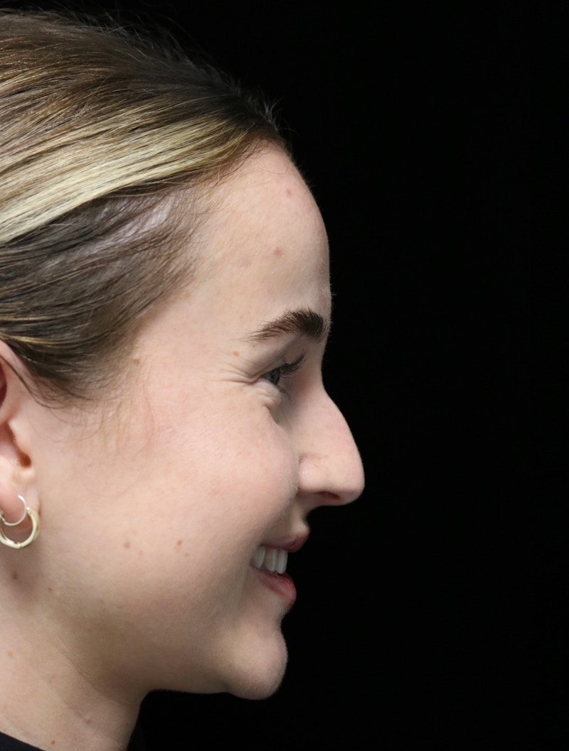 Beverly Hills Rhinoplasty Before & After Gallery - Patient 264675 - Image 3 Dr. Deepak Raj Dugar