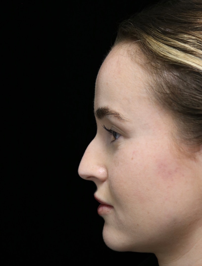 Beverly Hills Rhinoplasty Before & After Gallery - Patient 264675 - Image 11 Dr. Deepak Raj Dugar