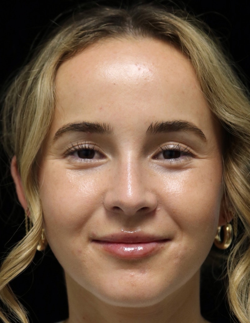 Beverly Hills Rhinoplasty Before & After Gallery - Patient 264675 - Image 6 Dr. Deepak Raj Dugar