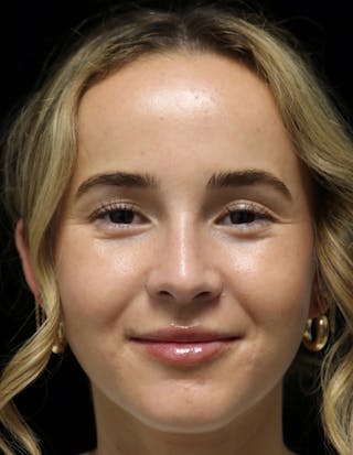 Beverly Hills Rhinoplasty Before & After Gallery - Patient 264675 - Image 6 Dr. Deepak Raj Dugar