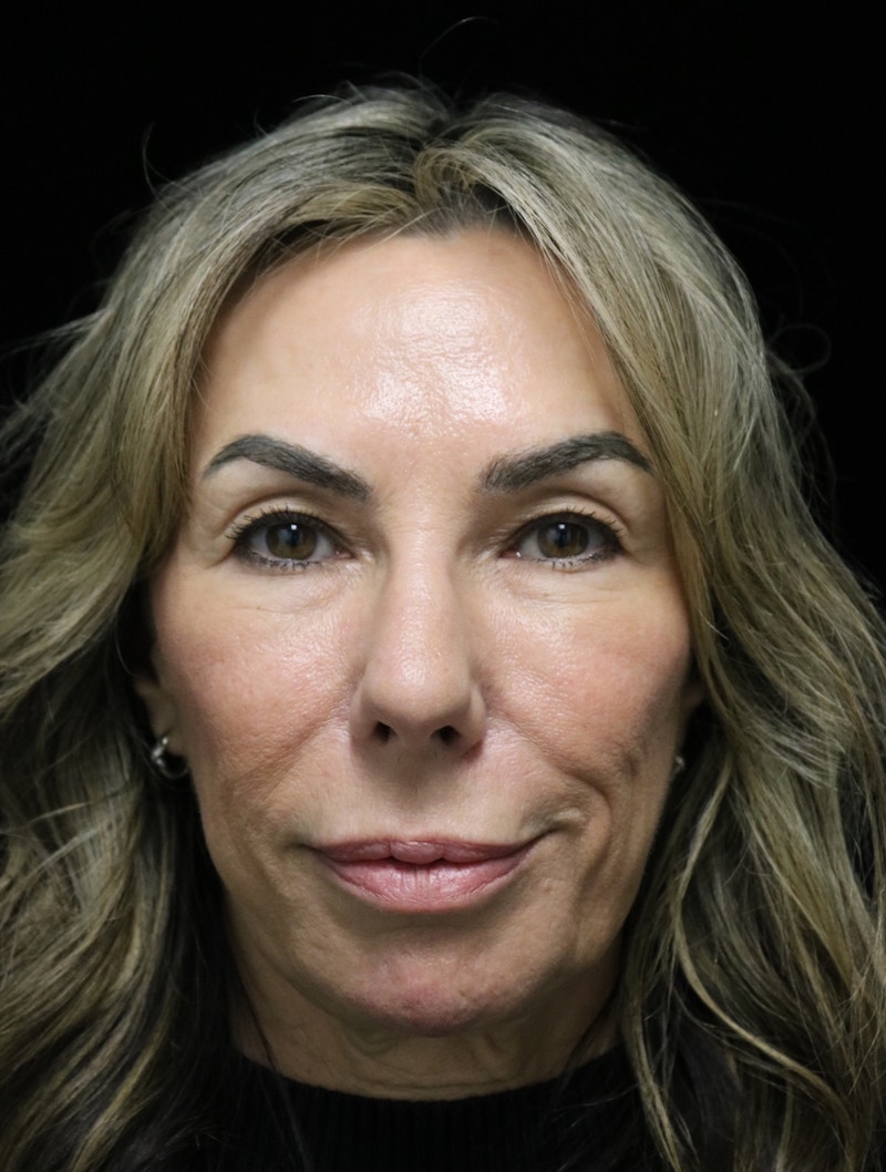 Beverly Hills Rhinoplasty Before & After Gallery - Patient 450098 - Image 6 Dr. Deepak Raj Dugar