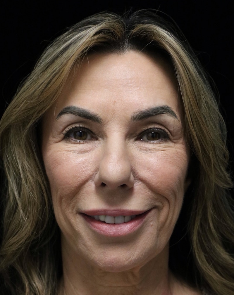 Beverly Hills Rhinoplasty Before & After Gallery - Patient 450098 - Image 7 Dr. Deepak Raj Dugar