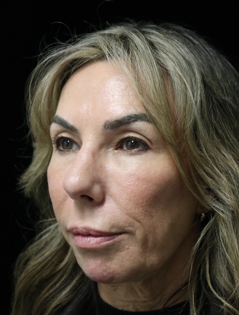 Beverly Hills Rhinoplasty Before & After Gallery - Patient 450098 - Image 10 Dr. Deepak Raj Dugar