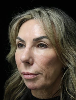 Beverly Hills Rhinoplasty Before & After Gallery - Patient 450098 - Image 10 Dr. Deepak Raj Dugar