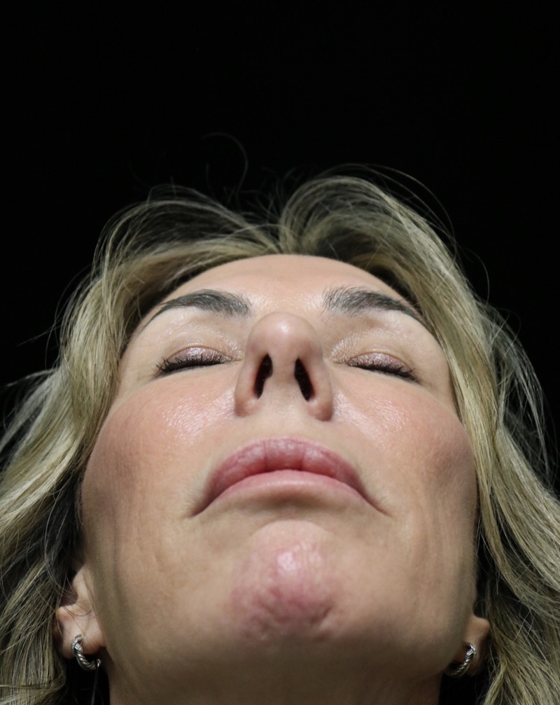 Beverly Hills Rhinoplasty Before & After Gallery - Patient 450098 - Image 14 Dr. Deepak Raj Dugar