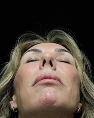 Beverly Hills Rhinoplasty Before & After Gallery - Patient 450098 - Image 14 Dr. Deepak Raj Dugar