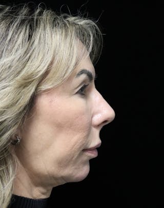 Beverly Hills Rhinoplasty Before & After Gallery - Patient 450098 - Image 2 Dr. Deepak Raj Dugar