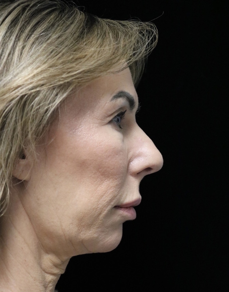 Beverly Hills Rhinoplasty Before & After Gallery - Patient 450098 - Image 1 Dr. Deepak Raj Dugar