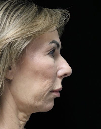 Beverly Hills Rhinoplasty Before & After Gallery - Patient 450098 - Image 1 Dr. Deepak Raj Dugar