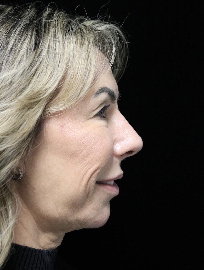 Beverly Hills Rhinoplasty Before & After Gallery - Patient 450098 - Image 4 Dr. Deepak Raj Dugar