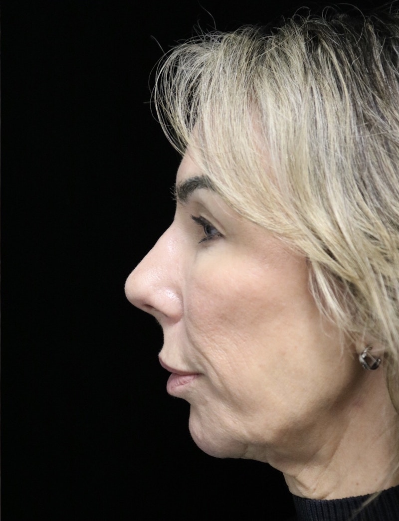 Beverly Hills Rhinoplasty Before & After Gallery - Patient 450098 - Image 12 Dr. Deepak Raj Dugar