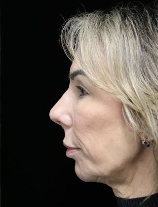 Beverly Hills Rhinoplasty Before & After Gallery - Patient 450098 - Image 12 Dr. Deepak Raj Dugar