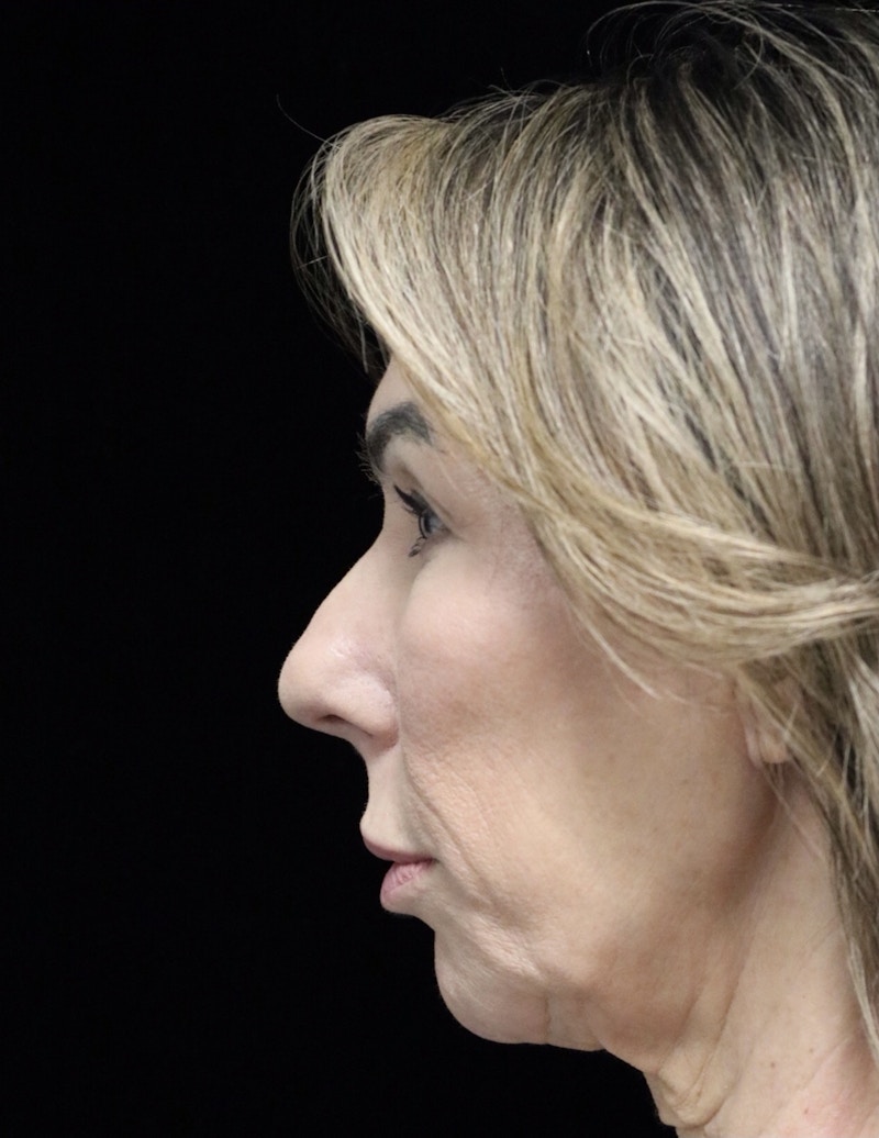 Beverly Hills Rhinoplasty Before & After Gallery - Patient 450098 - Image 11 Dr. Deepak Raj Dugar