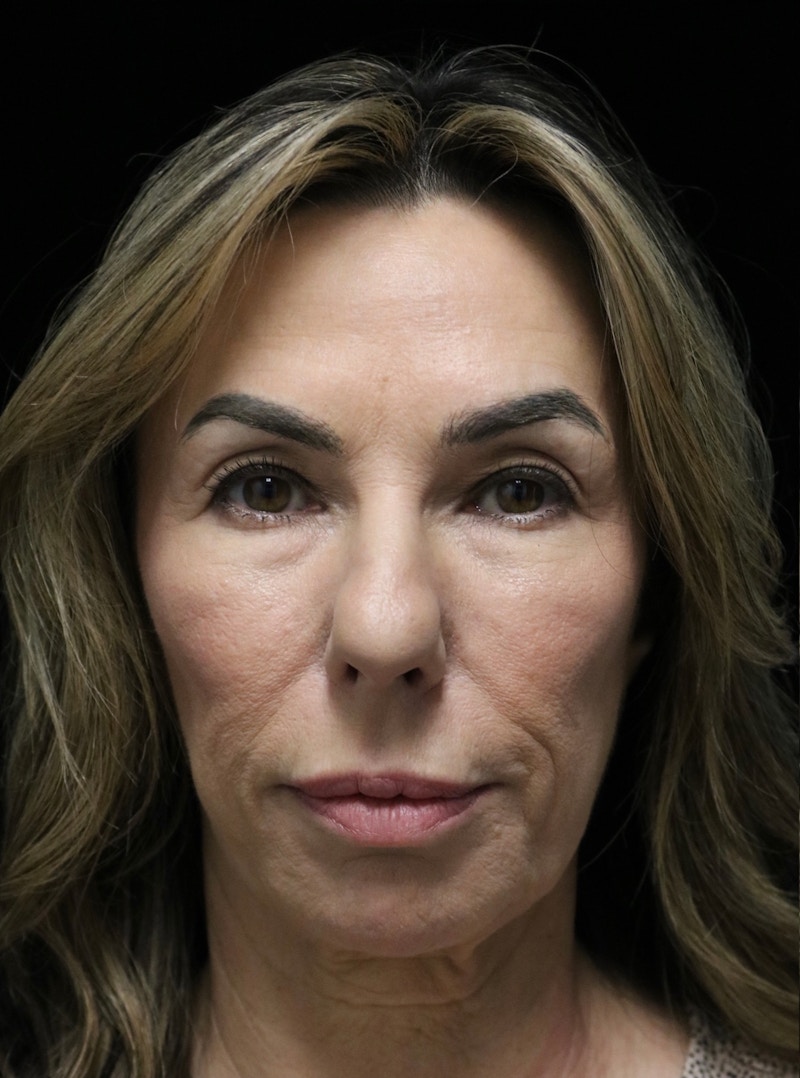 Beverly Hills Rhinoplasty Before & After Gallery - Patient 450098 - Image 5 Dr. Deepak Raj Dugar