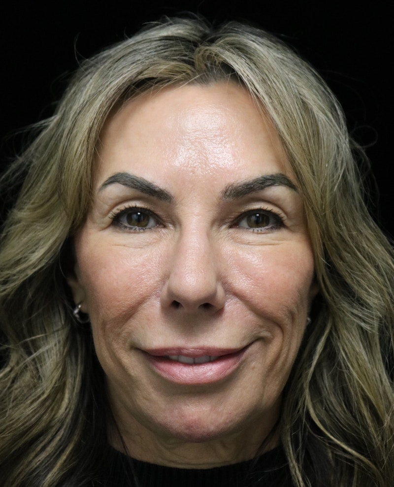 Beverly Hills Rhinoplasty Before & After Gallery - Patient 450098 - Image 8 Dr. Deepak Raj Dugar