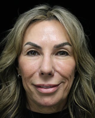 Beverly Hills Rhinoplasty Before & After Gallery - Patient 450098 - Image 8 Dr. Deepak Raj Dugar