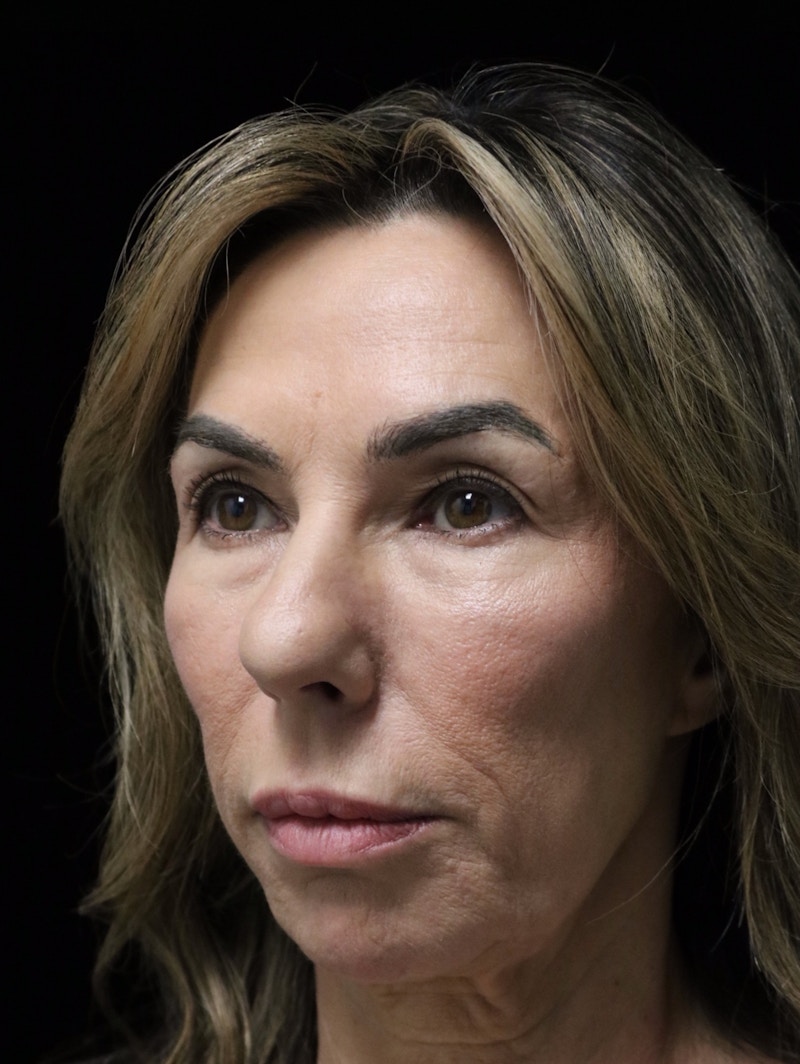 Beverly Hills Rhinoplasty Before & After Gallery - Patient 450098 - Image 9 Dr. Deepak Raj Dugar