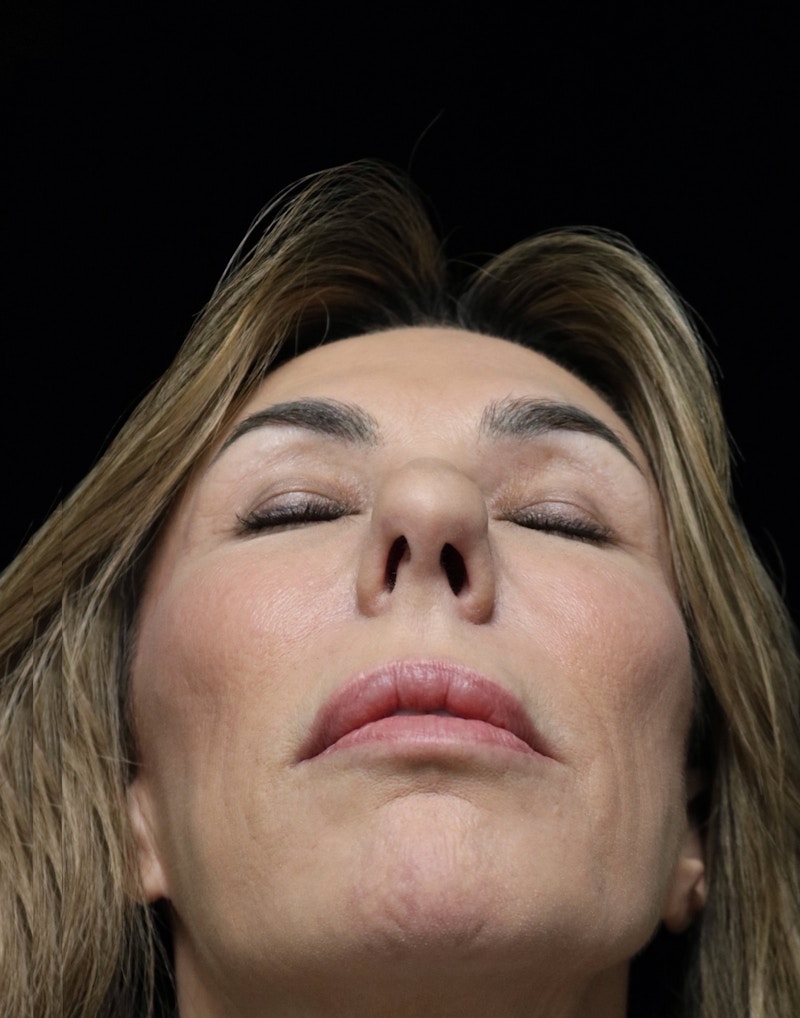 Beverly Hills Rhinoplasty Before & After Gallery - Patient 450098 - Image 13 Dr. Deepak Raj Dugar