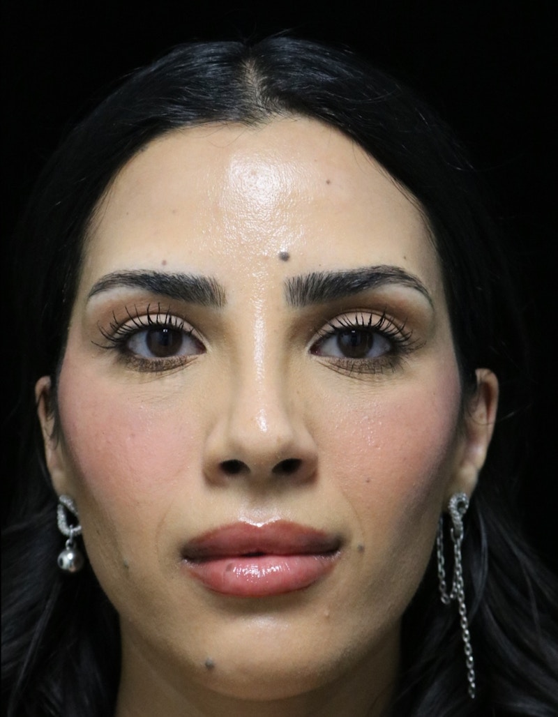 Beverly Hills Rhinoplasty Before & After Gallery - Patient 112724 - Image 8 Dr. Deepak Raj Dugar