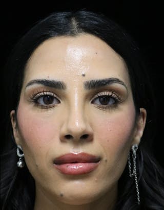 Beverly Hills Rhinoplasty Before & After Gallery - Patient 112724 - Image 8 Dr. Deepak Raj Dugar