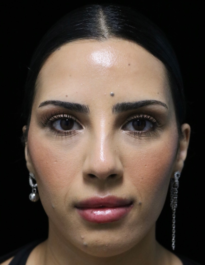 Beverly Hills Rhinoplasty Before & After Gallery - Patient 112724 - Image 7 Dr. Deepak Raj Dugar