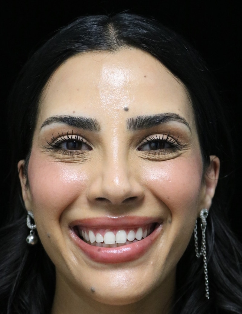 Beverly Hills Rhinoplasty Before & After Gallery - Patient 112724 - Image 10 Dr. Deepak Raj Dugar