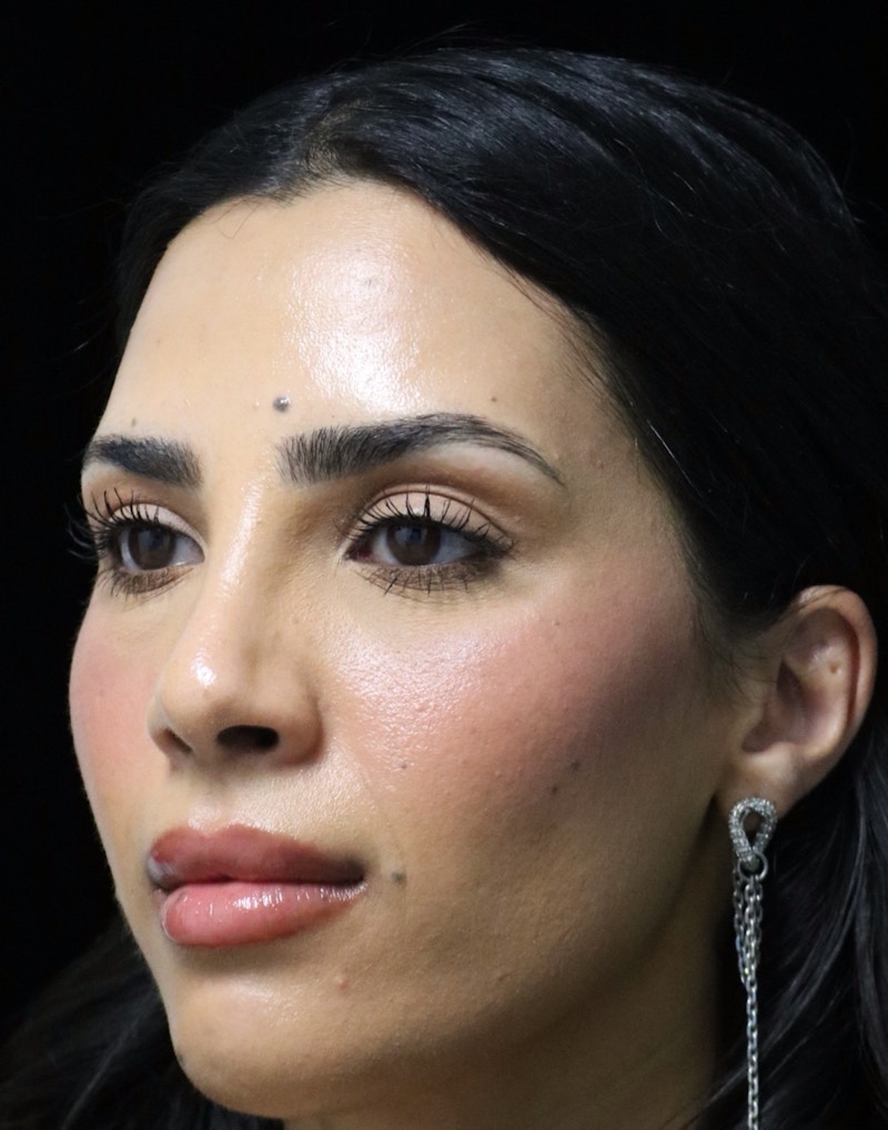 Beverly Hills Rhinoplasty Before & After Gallery - Patient 112724 - Image 12 Dr. Deepak Raj Dugar