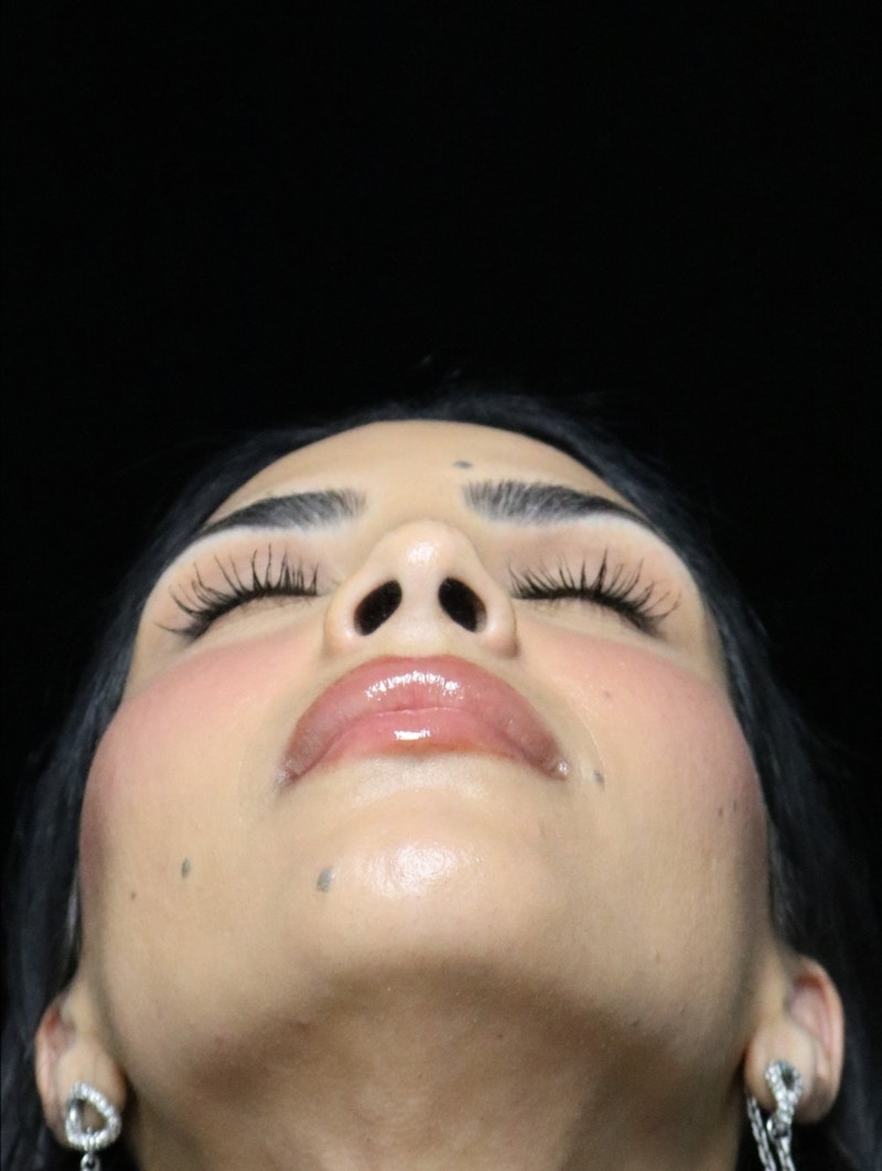 Beverly Hills Rhinoplasty Before & After Gallery - Patient 112724 - Image 5 Dr. Deepak Raj Dugar