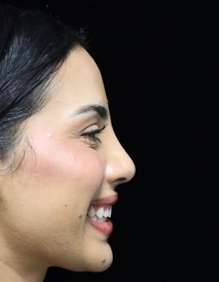 Beverly Hills Rhinoplasty Before & After Gallery - Patient 112724 - Image 4 Dr. Deepak Raj Dugar