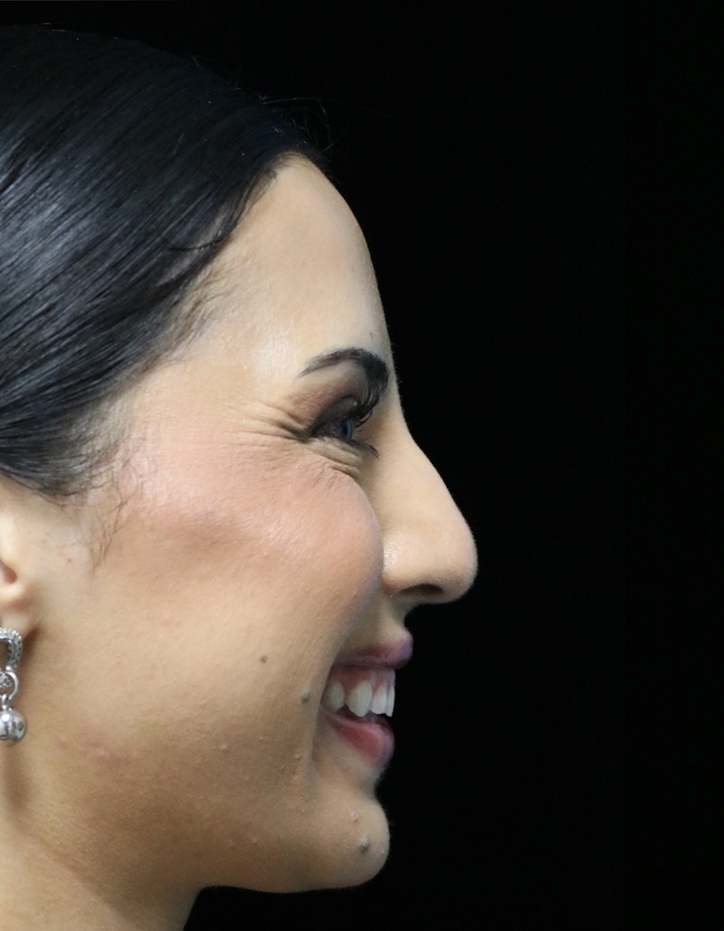 Beverly Hills Rhinoplasty Before & After Gallery - Patient 112724 - Image 3 Dr. Deepak Raj Dugar