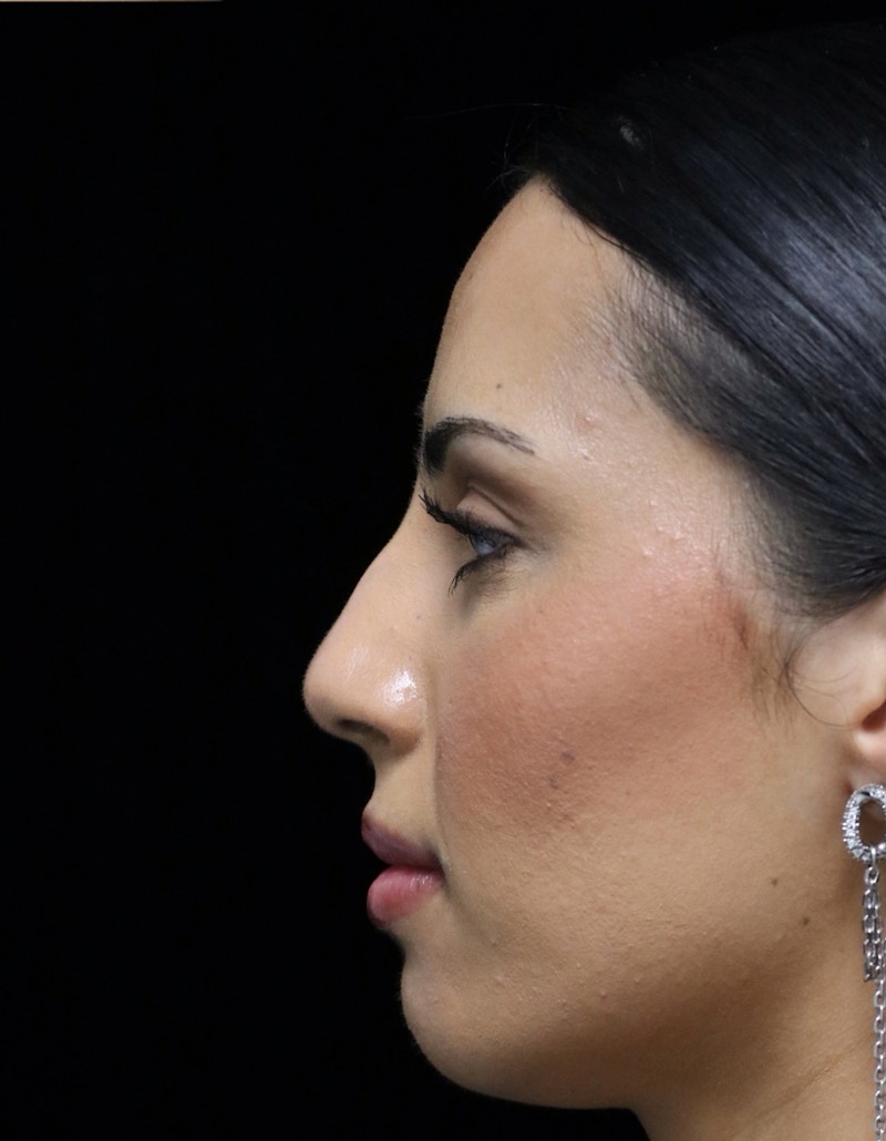 Beverly Hills Rhinoplasty Before & After Gallery - Patient 112724 - Image 13 Dr. Deepak Raj Dugar