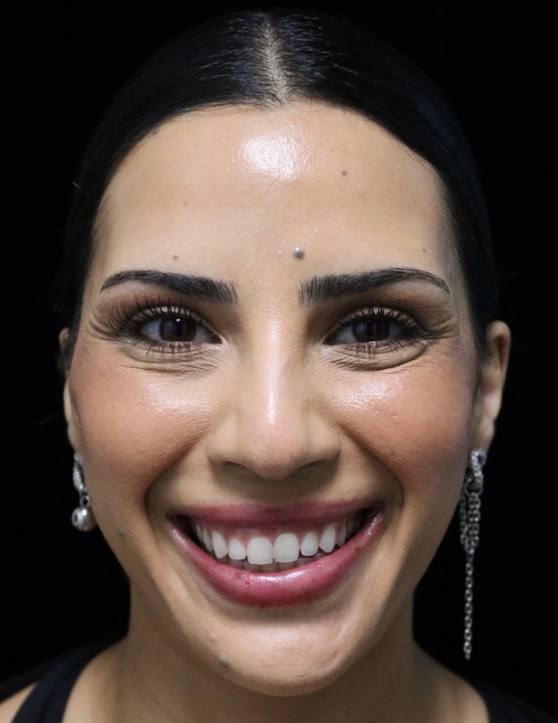 Beverly Hills Rhinoplasty Before & After Gallery - Patient 112724 - Image 9 Dr. Deepak Raj Dugar