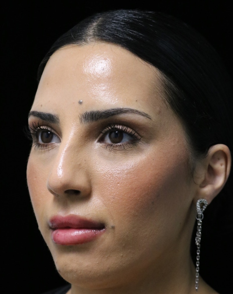 Beverly Hills Rhinoplasty Before & After Gallery - Patient 112724 - Image 11 Dr. Deepak Raj Dugar