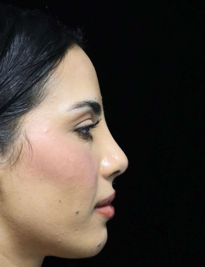 Beverly Hills Rhinoplasty Before & After Gallery - Patient 112724 - Image 2 Dr. Deepak Raj Dugar