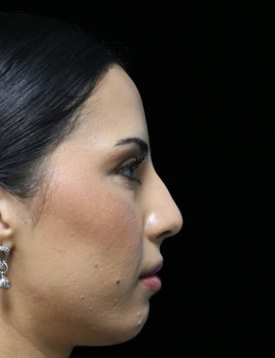 Beverly Hills Rhinoplasty Before & After Gallery - Patient 112724 - Image 1 Dr. Deepak Raj Dugar