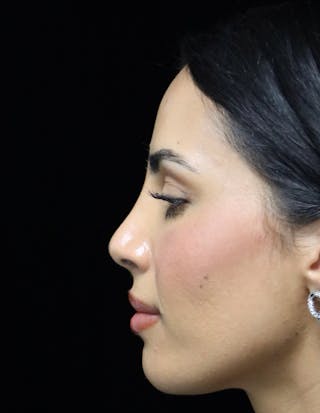 Beverly Hills Rhinoplasty Before & After Gallery - Patient 112724 - Image 14 Dr. Deepak Raj Dugar