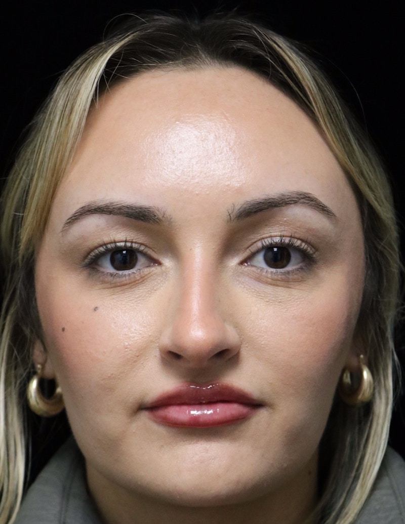 Beverly Hills Rhinoplasty Before & After Gallery - Patient 458018 - Image 5 Dr. Deepak Raj Dugar