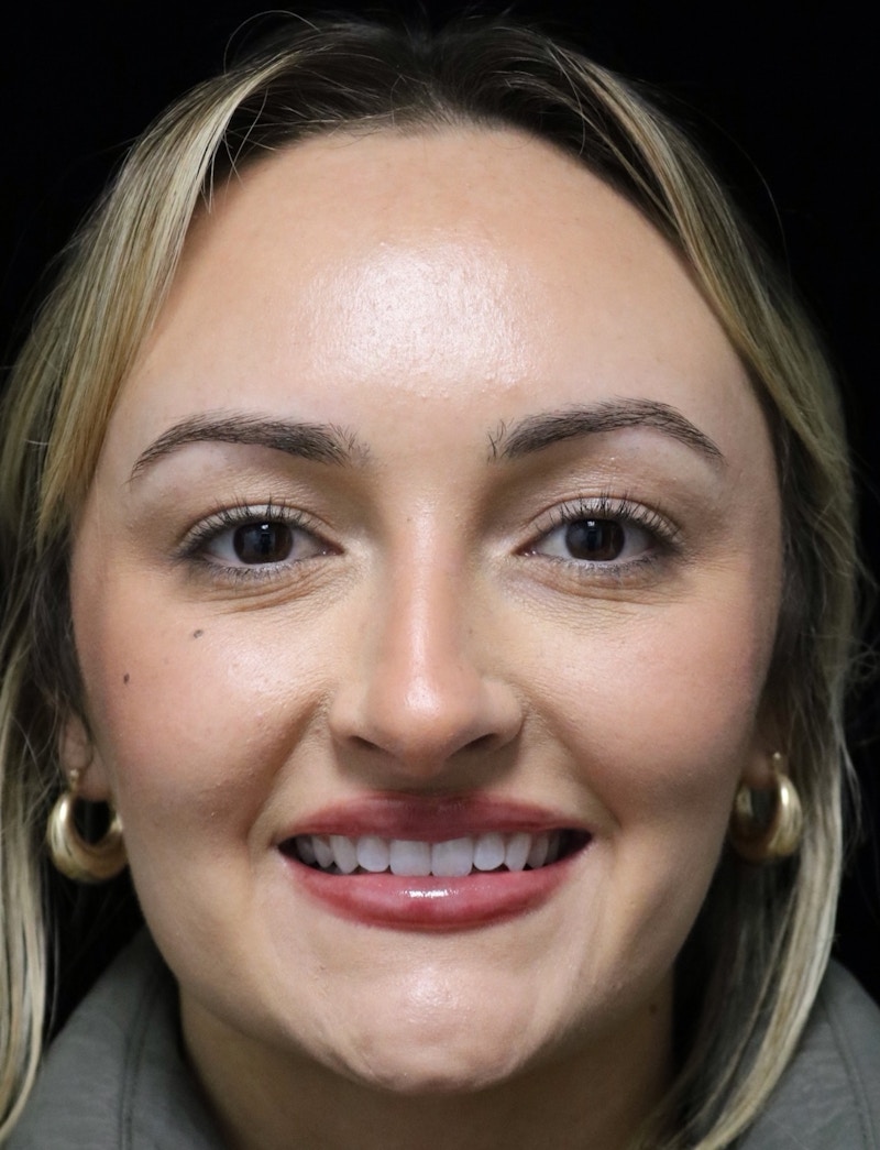 Beverly Hills Rhinoplasty Before & After Gallery - Patient 458018 - Image 7 Dr. Deepak Raj Dugar