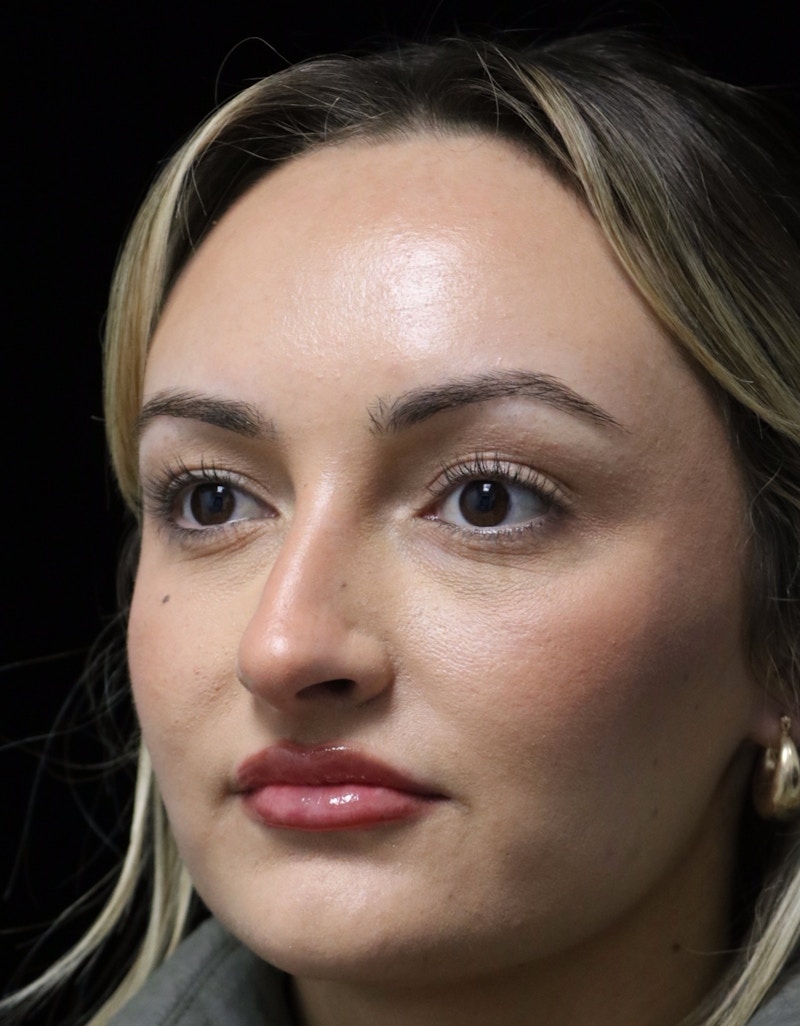 Beverly Hills Rhinoplasty Before & After Gallery - Patient 458018 - Image 9 Dr. Deepak Raj Dugar