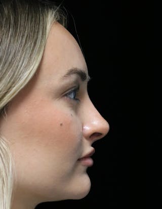 Beverly Hills Rhinoplasty Before & After Gallery - Patient 458018 - Image 2 Dr. Deepak Raj Dugar