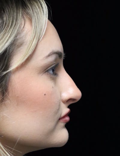Beverly Hills Rhinoplasty Before & After Gallery - Patient 458018 - Image 1 Dr. Deepak Raj Dugar