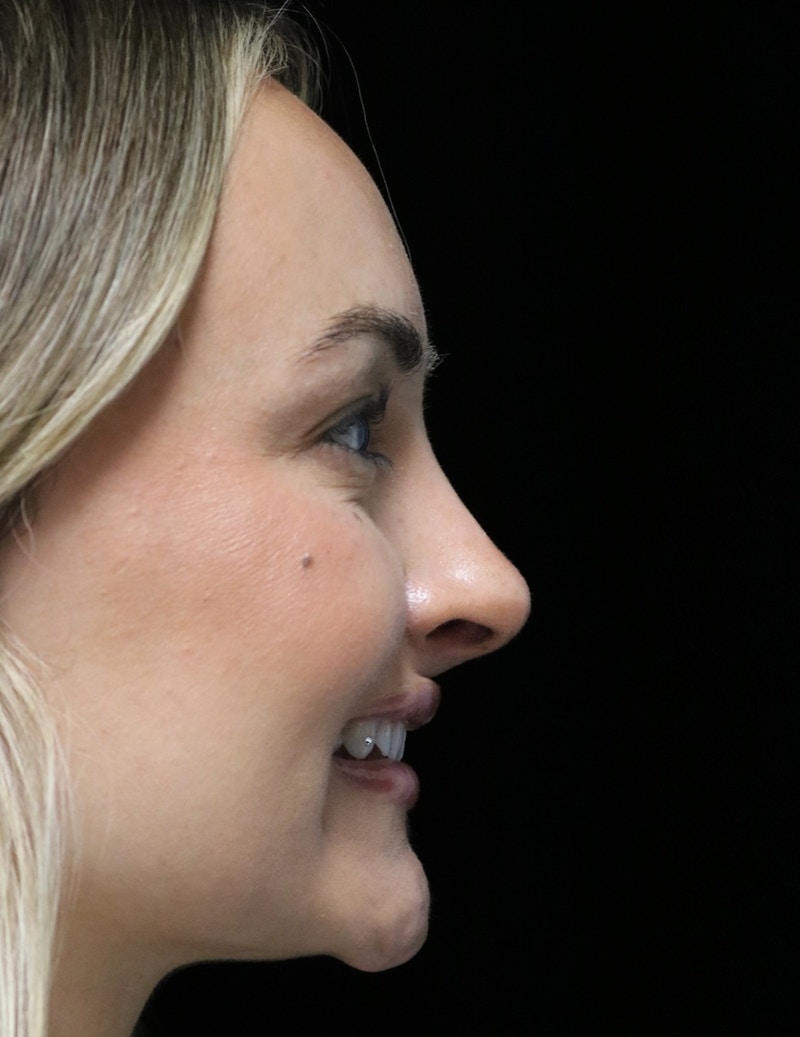 Beverly Hills Rhinoplasty Before & After Gallery - Patient 458018 - Image 4 Dr. Deepak Raj Dugar