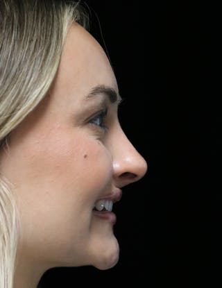 Beverly Hills Rhinoplasty Before & After Gallery - Patient 458018 - Image 4 Dr. Deepak Raj Dugar