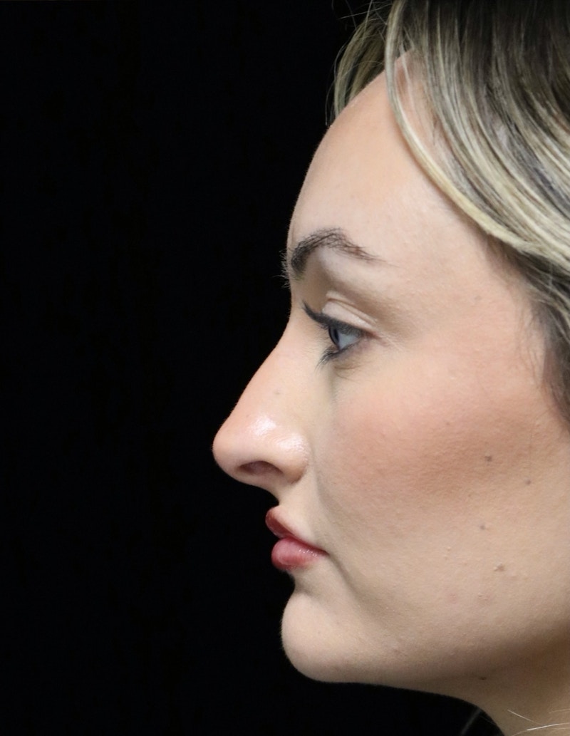 Beverly Hills Rhinoplasty Before & After Gallery - Patient 458018 - Image 13 Dr. Deepak Raj Dugar
