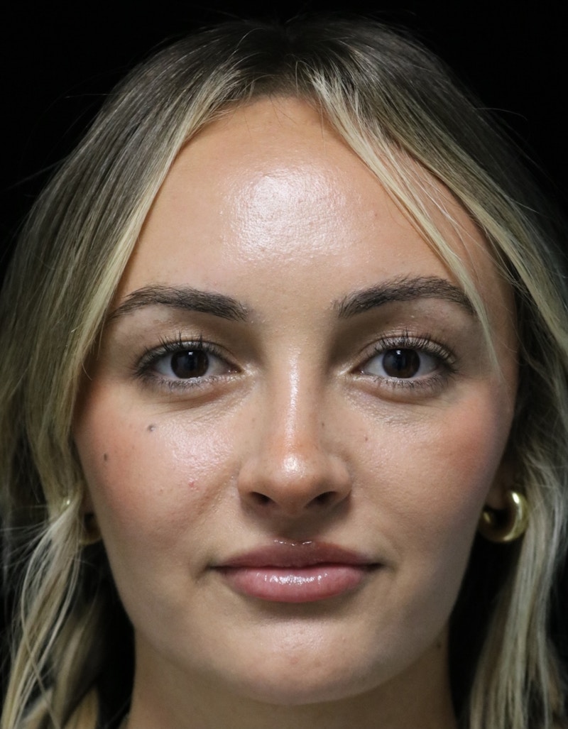Beverly Hills Rhinoplasty Before & After Gallery - Patient 458018 - Image 6 Dr. Deepak Raj Dugar