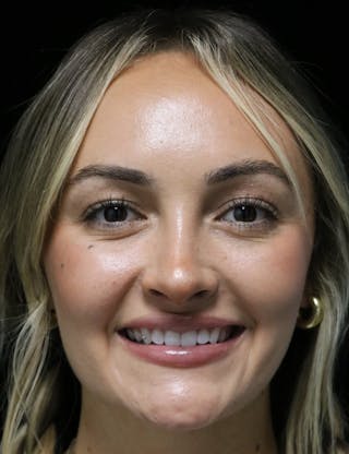 Beverly Hills Rhinoplasty Before & After Gallery - Patient 458018 - Image 8 Dr. Deepak Raj Dugar