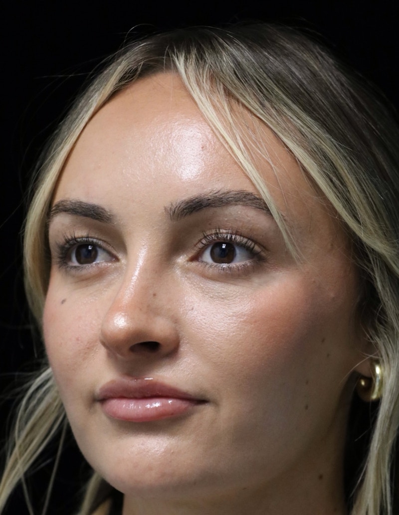Beverly Hills Rhinoplasty Before & After Gallery - Patient 458018 - Image 10 Dr. Deepak Raj Dugar