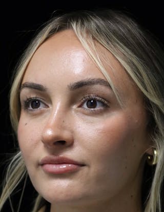 Beverly Hills Rhinoplasty Before & After Gallery - Patient 458018 - Image 10 Dr. Deepak Raj Dugar