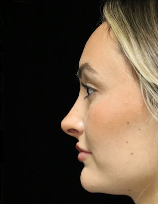 Beverly Hills Rhinoplasty Before & After Gallery - Patient 458018 - Image 14 Dr. Deepak Raj Dugar